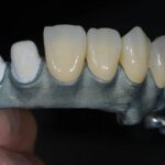 fogpótlás fogászat